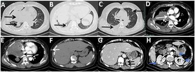 Case report: Disseminated mucormycosis misdiagnosed as malignancy developed from allergic bronchopulmonary mycosis caused by Rhizopus microsporus following SARS-CoV-2 infection in a woman